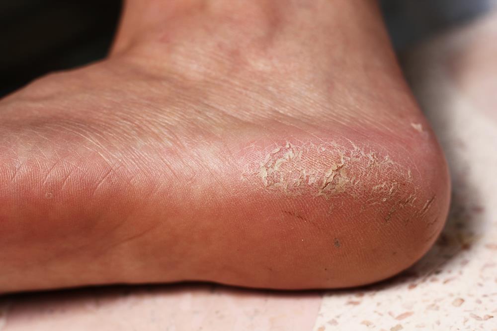 Calluses  Lowell, MA 